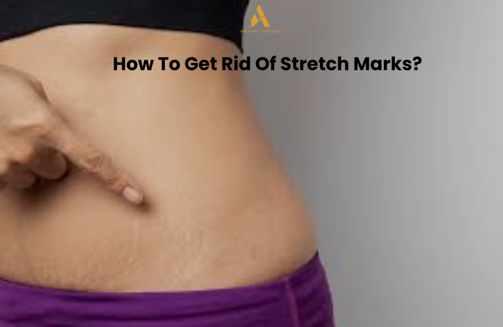 Stretch marks on stomach – Treatment by Dr. Atieka Agrawwal, Best Dermatologist in Indore for Laser Stretch Mark Removal