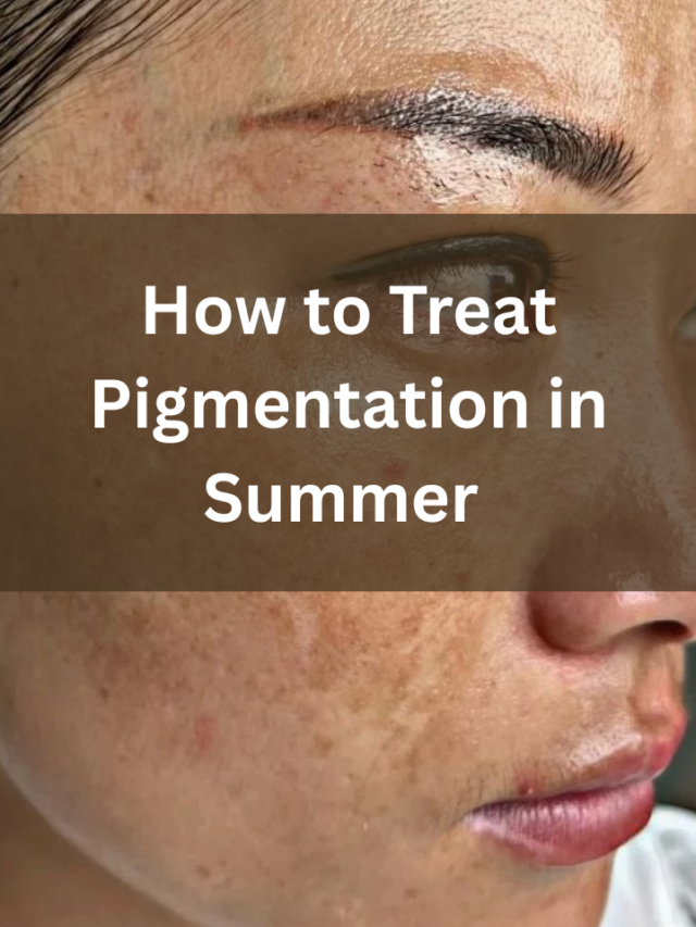How to Treat Pigmentation in Summer | Dr. Atieka Agrawal, Indore