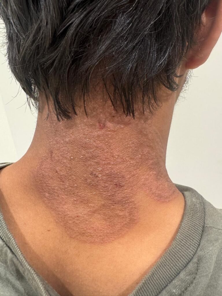 MEN with red irritated skin on the back of his neck— highlighting top skin problems and treatments available at Dr. Atieka Agrawwal's Skin, Hair & Laser Clinic in Indore."